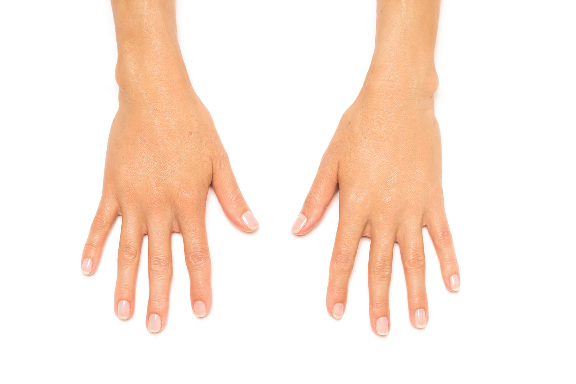 Après traitement de Radiesse® à l'Institut Figurra - Patient 1