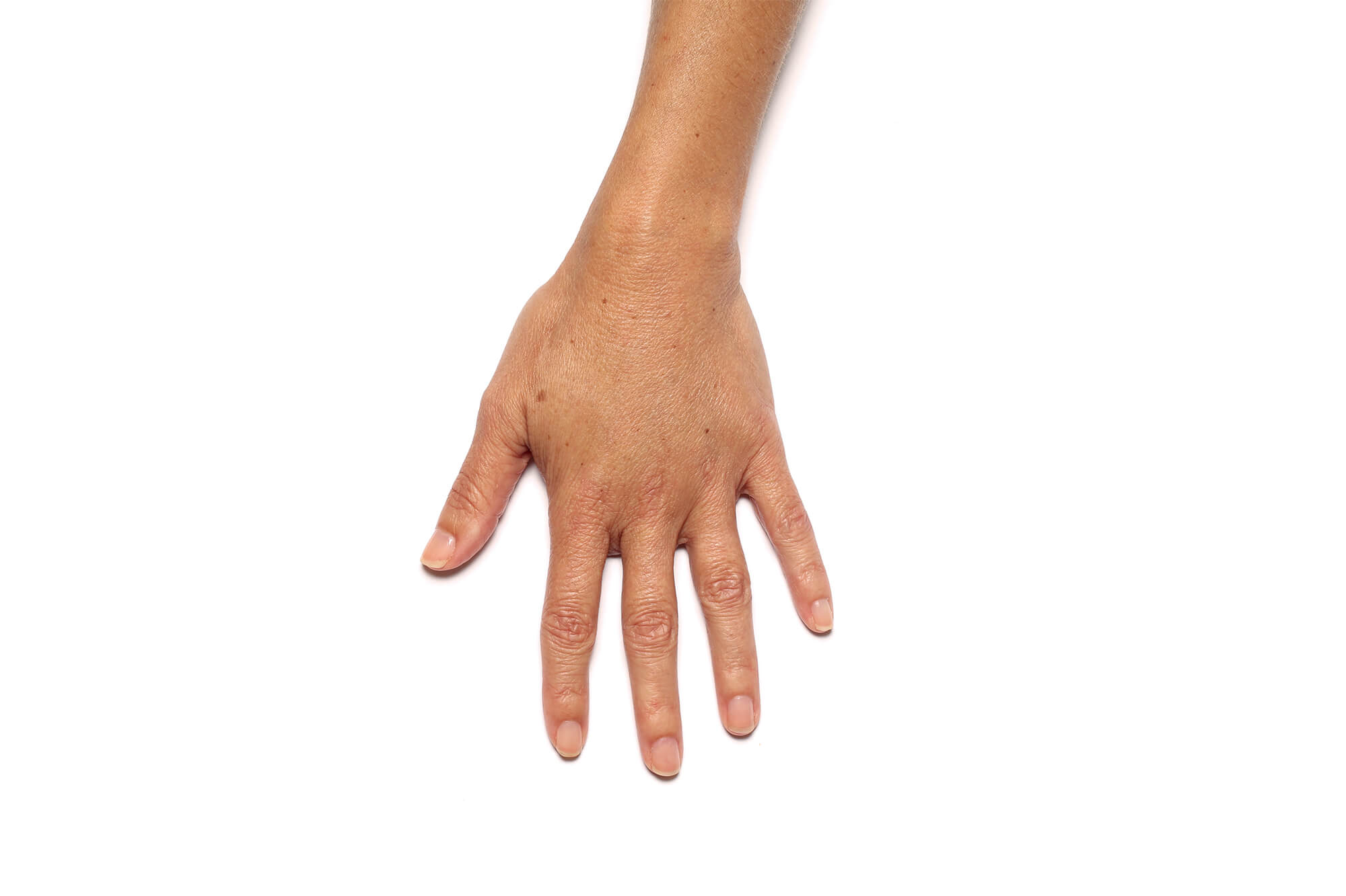 Après traitement de Radiesse® à l'Institut Figurra - Patient 2