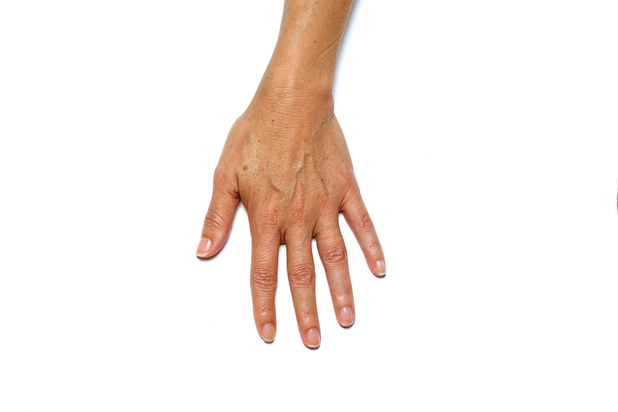 Avant traitement de Radiesse® à l'Institut Figurra - Patient 2