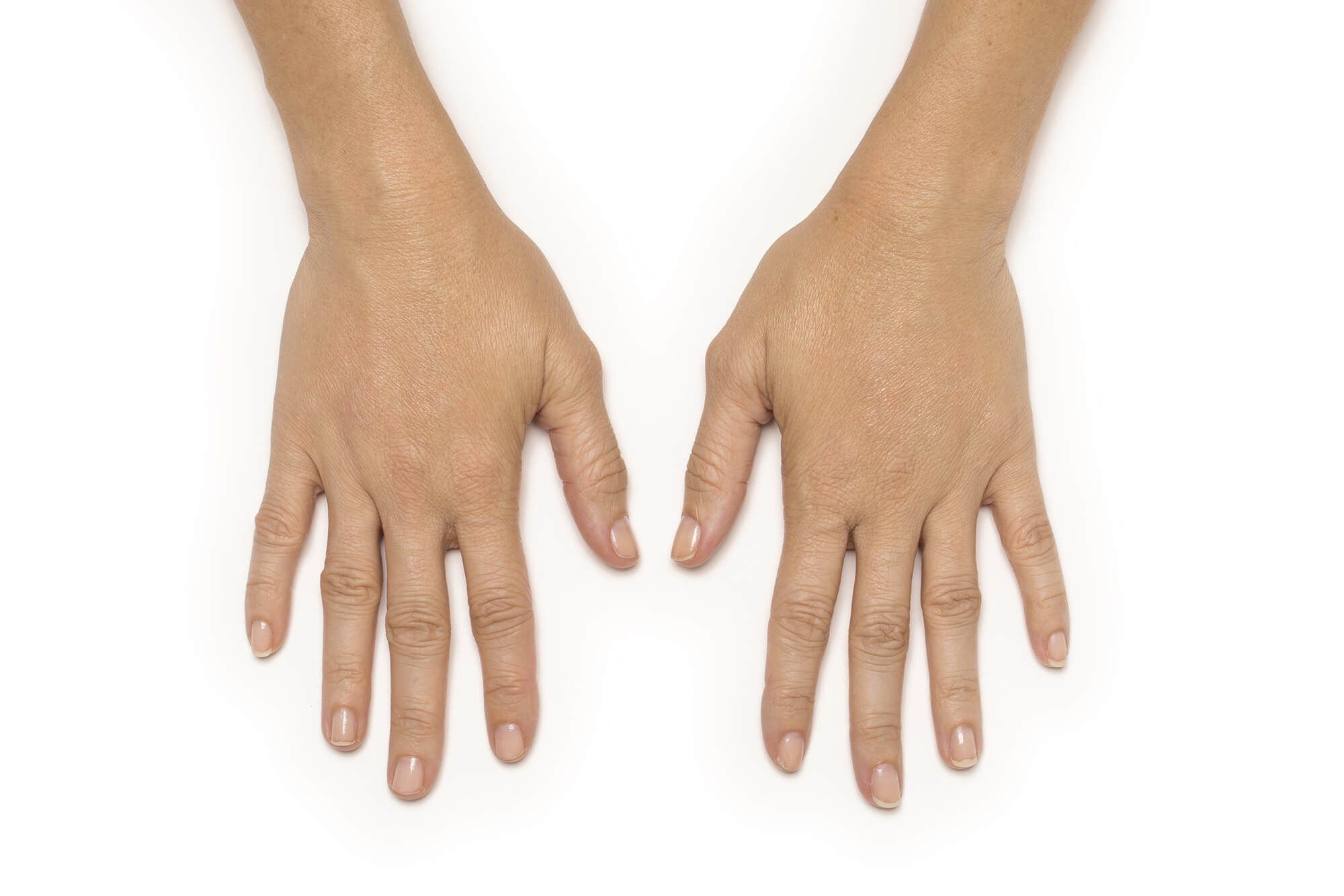 Après traitement de Radiesse® à l'Institut Figurra - Patient 3