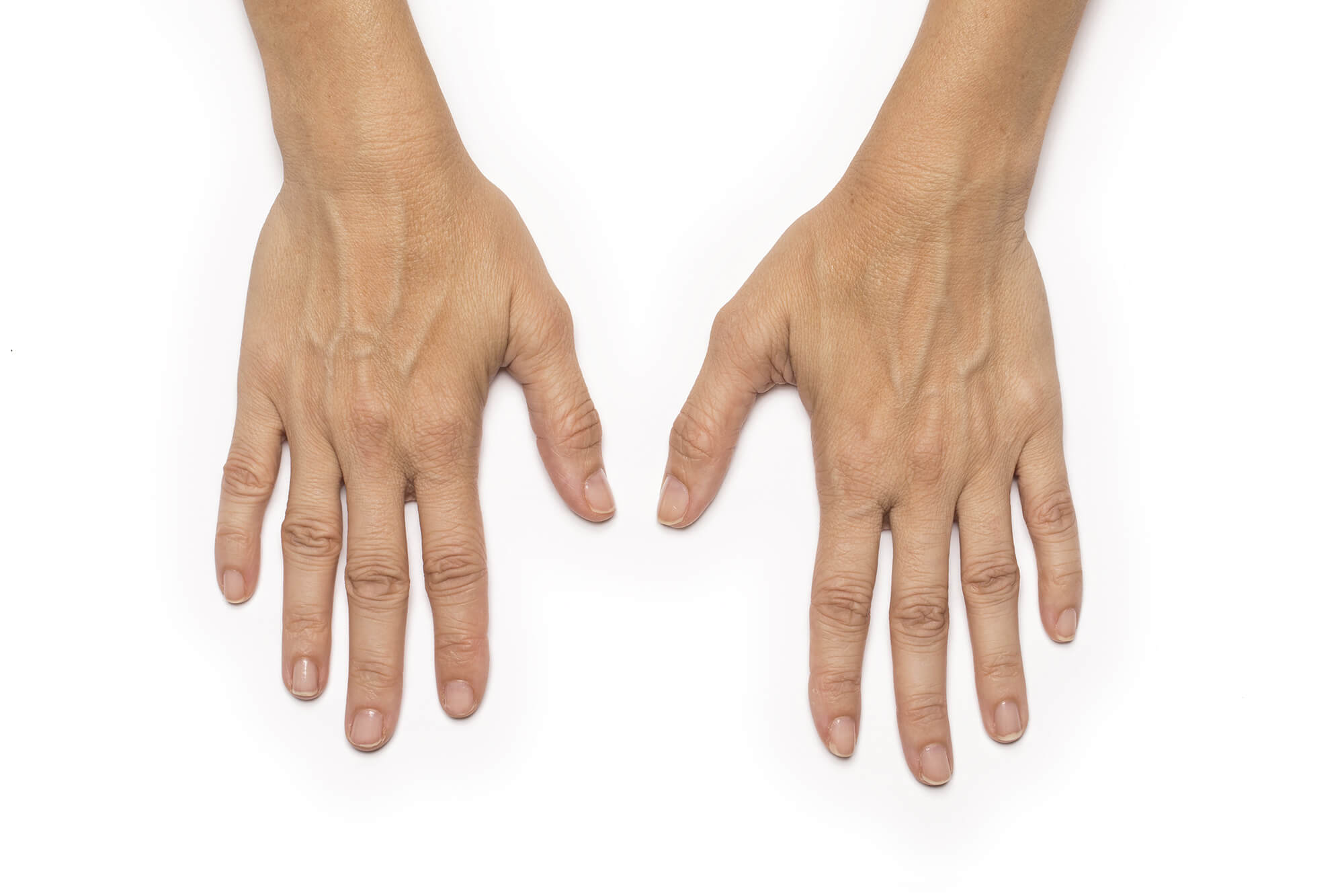 Avant traitement de Radiesse® à l'Institut Figurra - Patient 3