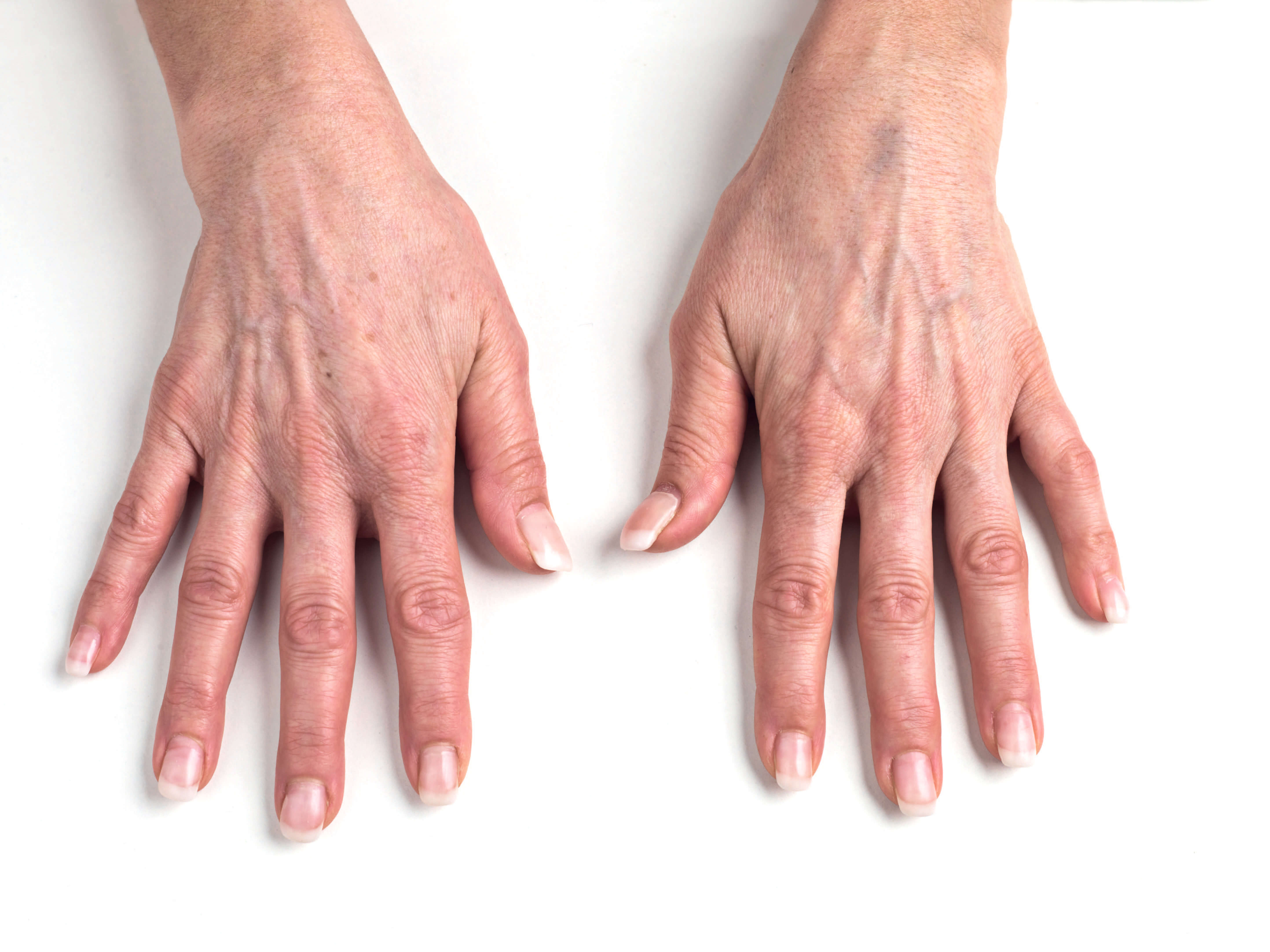 Avant traitement de Radiesse® à l'Institut Figurra - Patient 4