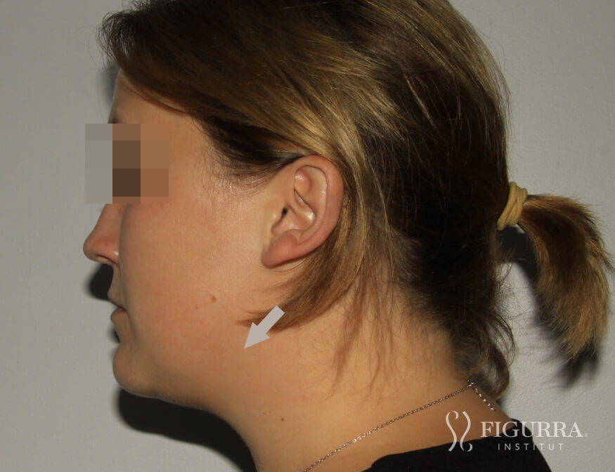 After Belkyra - Lypolysis treatment at Figurra Institute - Patient 1