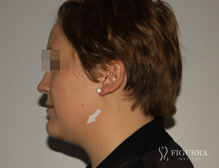 Before Belkyra - Lypolysis treatment at Figurra Institute - Patient 1