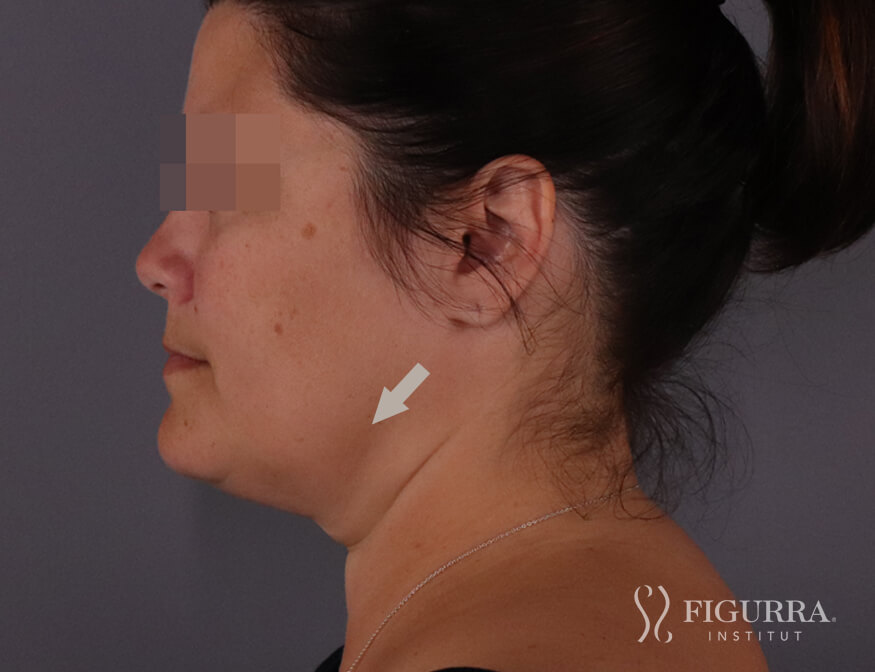 After Belkyra - Lypolysis treatment at Figurra Institute - Patient 2