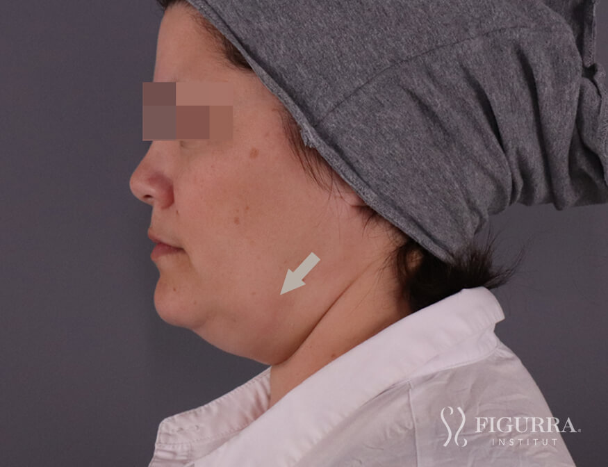 Before Belkyra - Lypolysis treatment at Figurra Institute - Patient 2