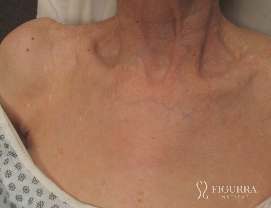 After surgical excision and cryotherapy treatment at Figurra Institute - Patient 6