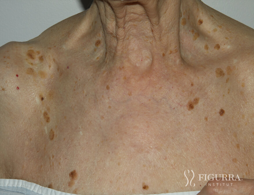 Before surgical excision and cryotherapy treatment at Figurra Institute - Patient 6