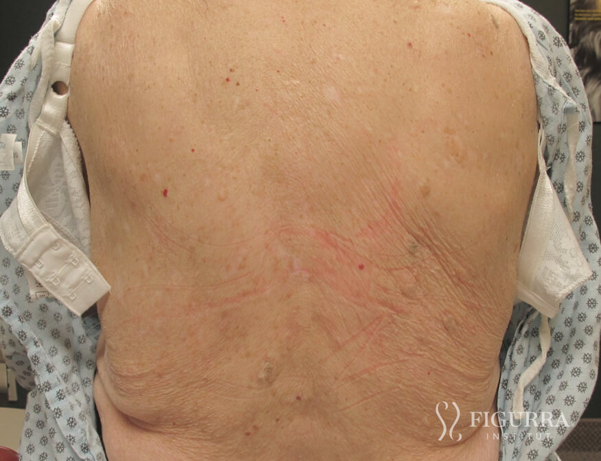 After surgical excision and cryotherapy treatment at Figurra Institute - Patient 7