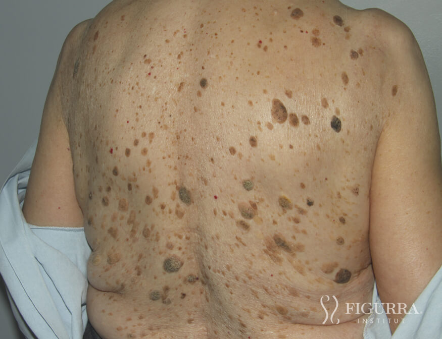 Before surgical excision and cryotherapy treatment at Figurra Institute - Patient 7