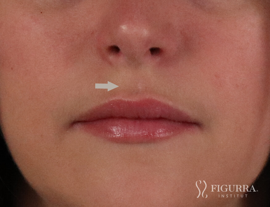 After surgical excision and cryotherapy treatment at Figurra Institute - Patient 1