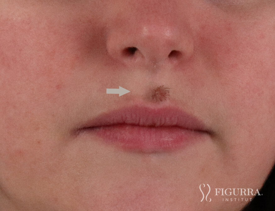 Before surgical excision and cryotherapy treatment at Figurra Institute - Patient 1