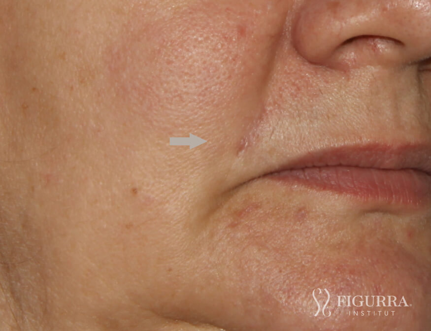 After surgical excision and cryotherapy treatment at Figurra Institute - Patient 2