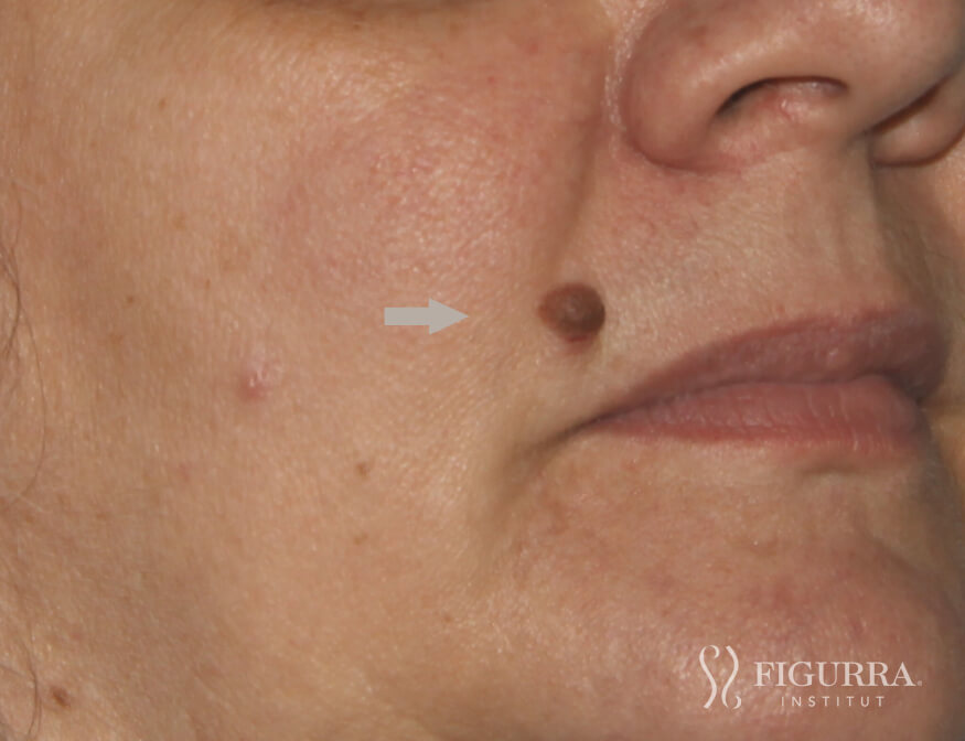 Before surgical excision and cryotherapy treatment at Figurra Institute - Patient 2