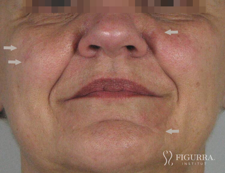 After surgical excision and cryotherapy treatment at Figurra Institute - Patient 3