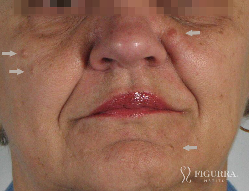 Before surgical excision and cryotherapy treatment at Figurra Institute - Patient 3