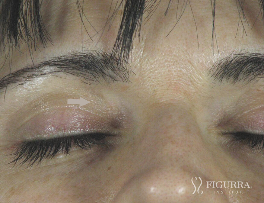 After surgical excision and cryotherapy treatment at Figurra Institute - Patient 4