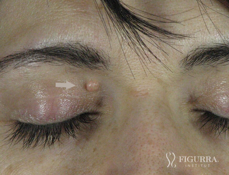 Before surgical excision and cryotherapy treatment at Figurra Institute - Patient 4