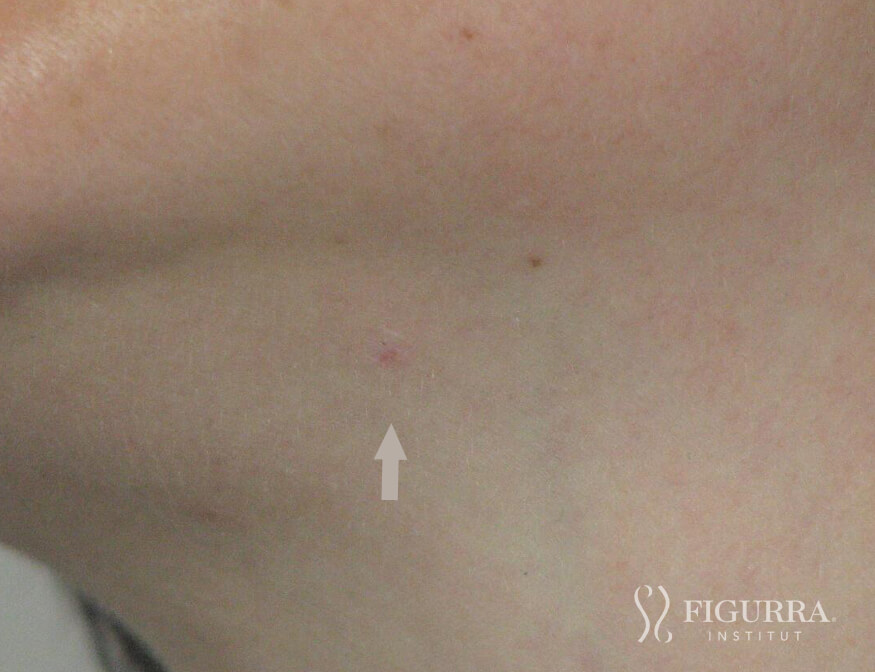 After surgical excision and cryotherapy treatment at Figurra Institute - Patient 5
