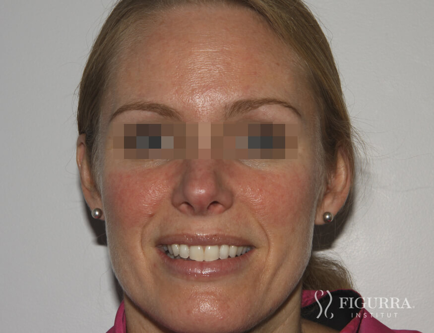 Case of rosacea/couperose after treatment at Figurra Institute - Patient 1