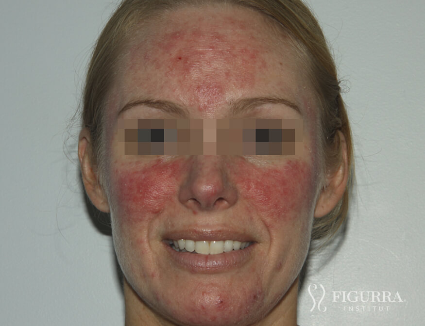 Case of rosacea/couperose before treatment at Figurra Institute - Patient 1