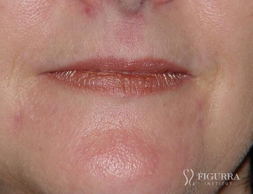 Case of rosacea/couperose after treatment at Figurra Institute - Patient 2
