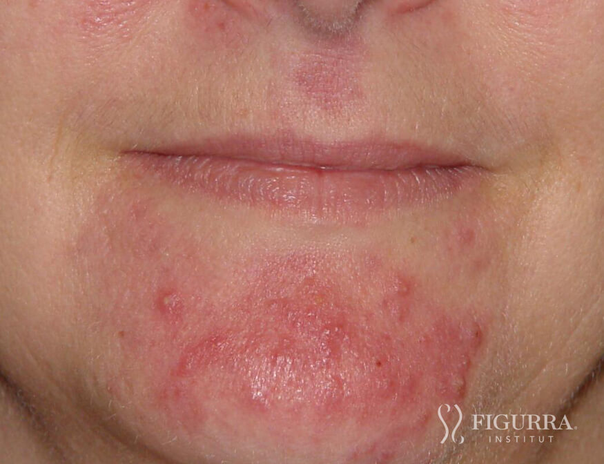 Case of rosacea/couperose before treatment at Figurra Institute - Patient 2