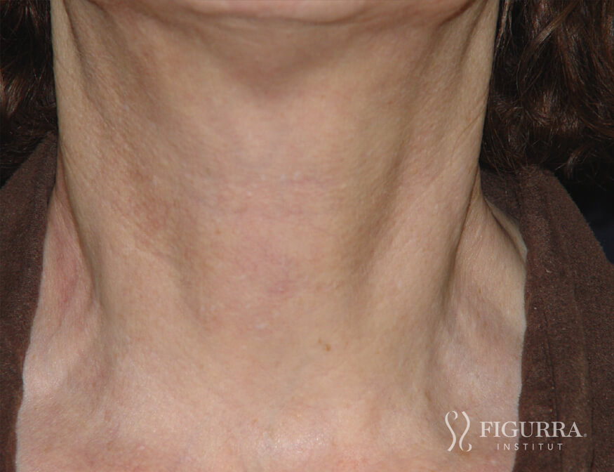 Case of rosacea/couperose after treatment at Figurra Institute - Patient 3