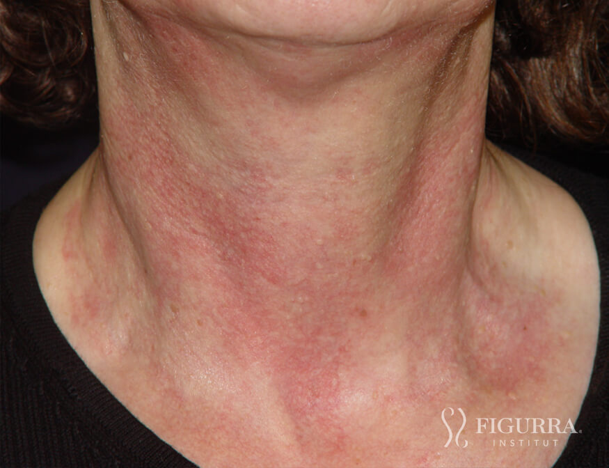 Case of rosacea/couperose before treatment at Figurra Institute - Patient 3