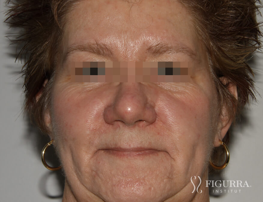 Case of rosacea/couperose after treatment at Figurra Institute - Patient 4