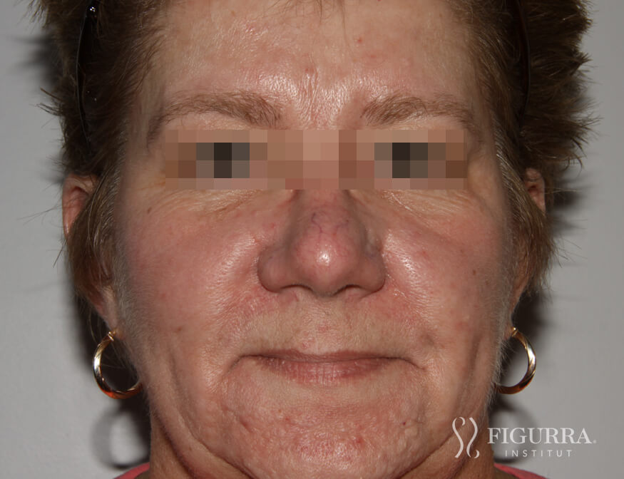 Case of rosacea/couperose before treatment at Figurra Institute - Patient 4