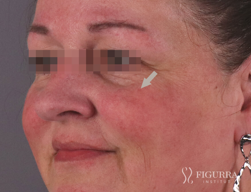 Case of rosacea/couperose after treatment at Figurra Institute - Patient 6