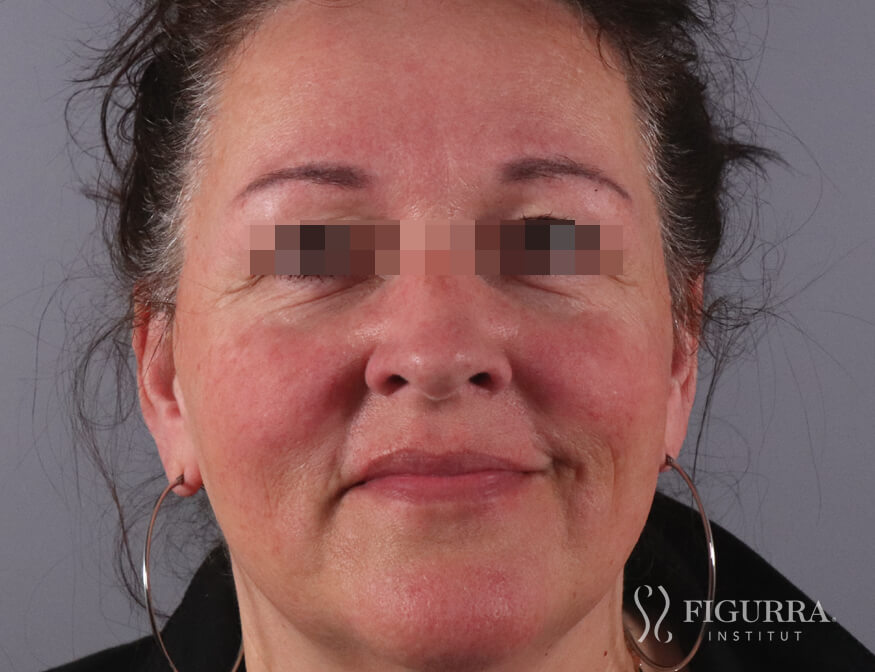 Case of rosacea/couperose after treatment at Figurra Institute - Patient 5