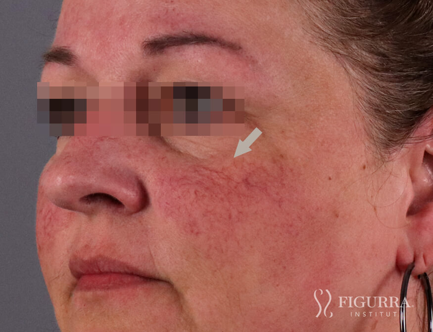 Case of rosacea/couperose before treatment at Figurra Institute - Patient 6