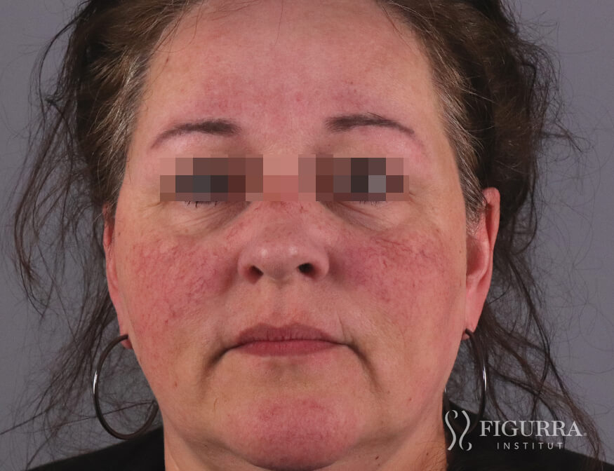 Case of rosacea/couperose before treatment at Figurra Institute - Patient 5